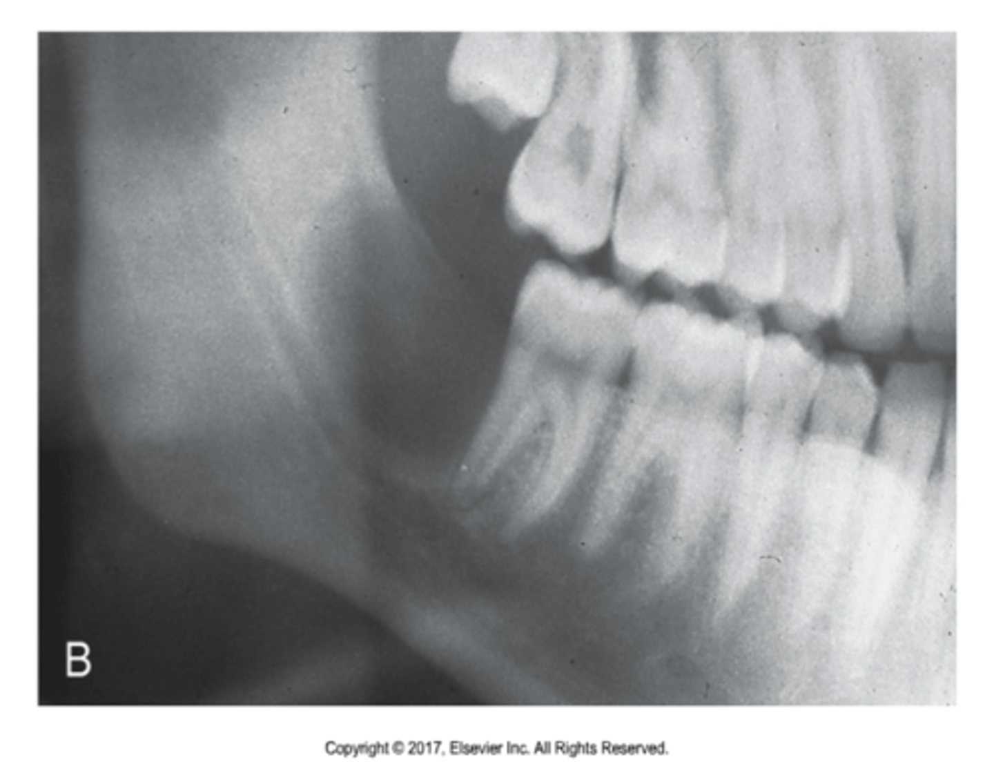 <p>-size</p><p>-borders (well-defined, corticated, punched out, poorly-defined)</p><p>-location (below or tooth bearing area of jaw, apex of non-vital tooth, lateral root, pericoronal)</p><p>-effect on neighboring teeth (displacement/root resorption, destruction surrounding intact roots)</p><p>-effect on cortical bone (no effect, expansion but cortex intact, destruction of cortex but no expansion)</p>