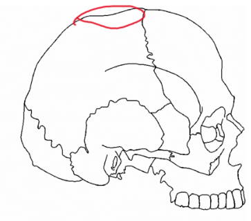 <p>white = no depression, black = depressed, asian = no depression</p>