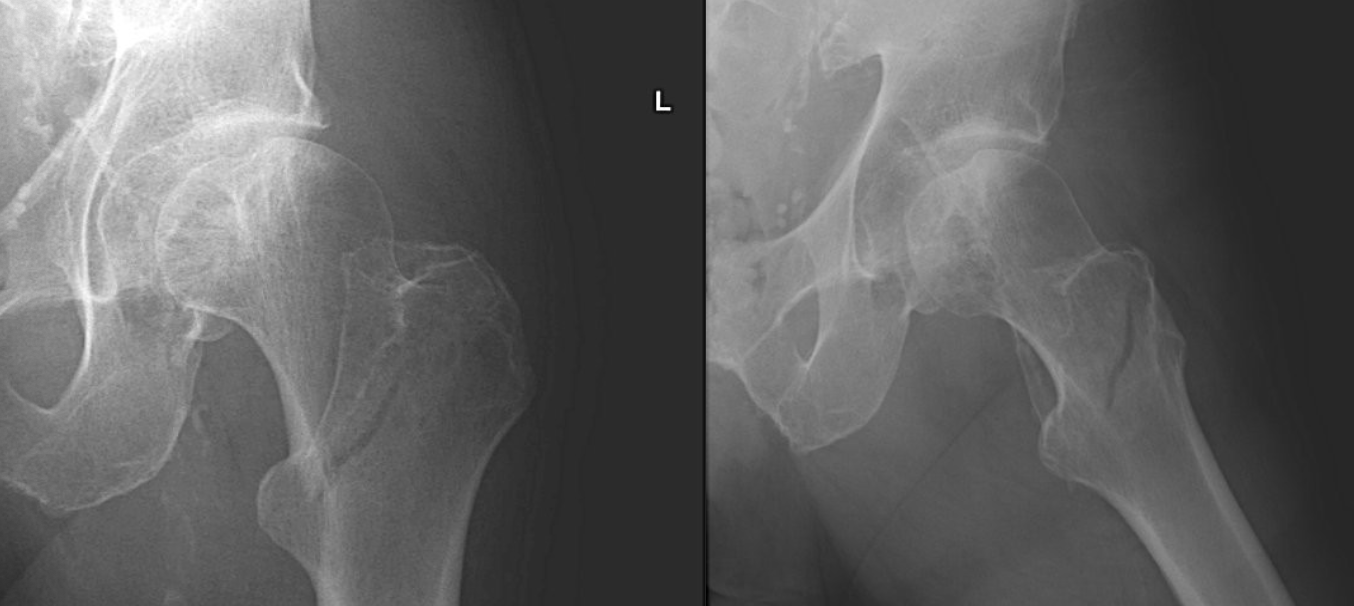 <p>Name this fracture</p>