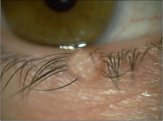 <ul><li><p><strong>poxvirus</strong></p></li></ul><p></p><ul><li><p>mildly <strong>contagious</strong> (skin to skin)</p></li></ul><p></p><ul><li><p><mark data-color="green" style="background-color: green; color: inherit;">umbilicate</mark>d skin nodule → 2-3mm</p></li></ul><p></p><ul><li><p>viral toxins may cause follicular conjunctivitis</p></li></ul><p></p><ul><li><p><mark data-color="green" style="background-color: green; color: inherit;">curette</mark> lesions → local or general anaesthetic</p></li></ul><p>—> moluscumi scraped out&nbsp;</p><p></p>