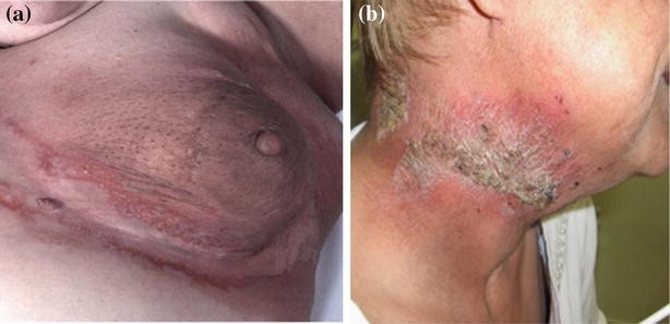 <p>impairment of lymph drainage resulting in <strong>edema </strong></p>