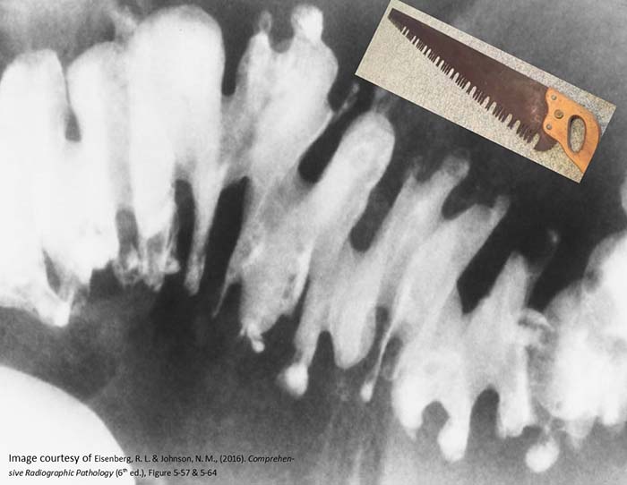 <p>At what age is diverticulosis uncommon?</p>