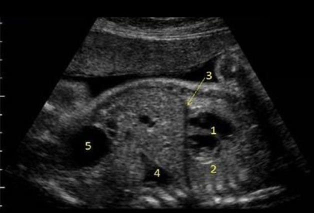 <p>what is #5</p><p>a) stomach</p><p>b) hydronephrosis</p><p>c) lung tissue</p><p>d) bladder</p>