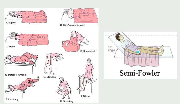 <p>Prone position allows for lung expansion</p>