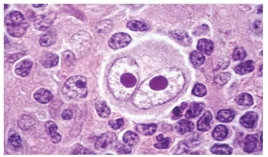 <ul><li><p>Hodgkin Lymphoma - characterized by presence of Reed-Sternberg cells</p></li><li><p class="has-focus">Non-Hodgkin Lymphoma</p></li></ul><p></p>