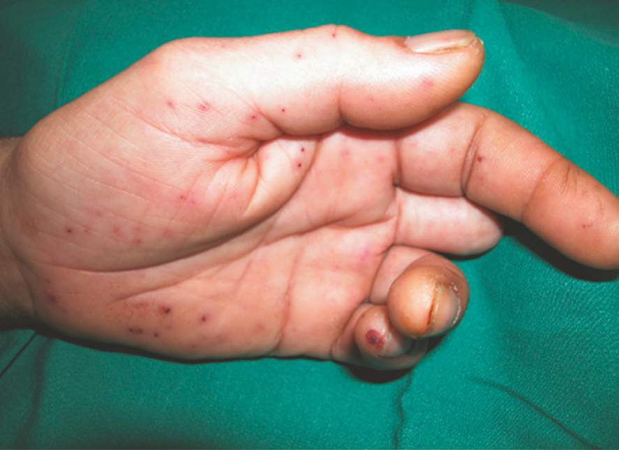 <ul><li><p>non-tender, late peripheral sign of<strong> infective endocarditis</strong></p></li><li><p>found on the palms or finger pulps and are thought to be <strong>septic emboli </strong></p></li><li><p>rarely seen in western cultures due to advances in medical treatment</p></li></ul><p></p>