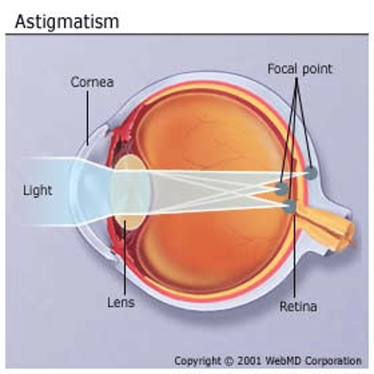 <p>Irregular curvature of the lens or cornea</p>