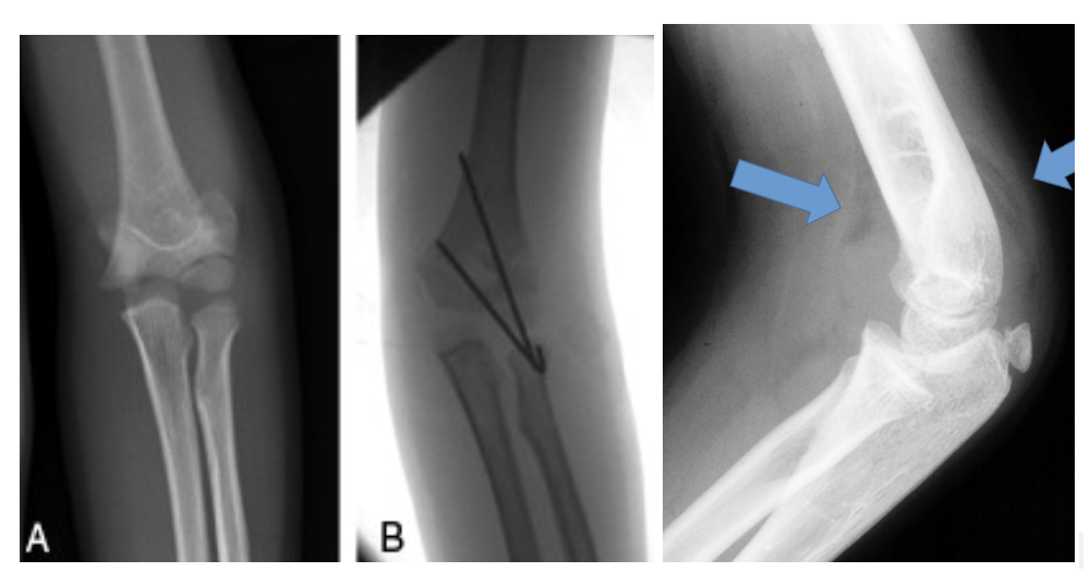 <p>Name this fracture</p>