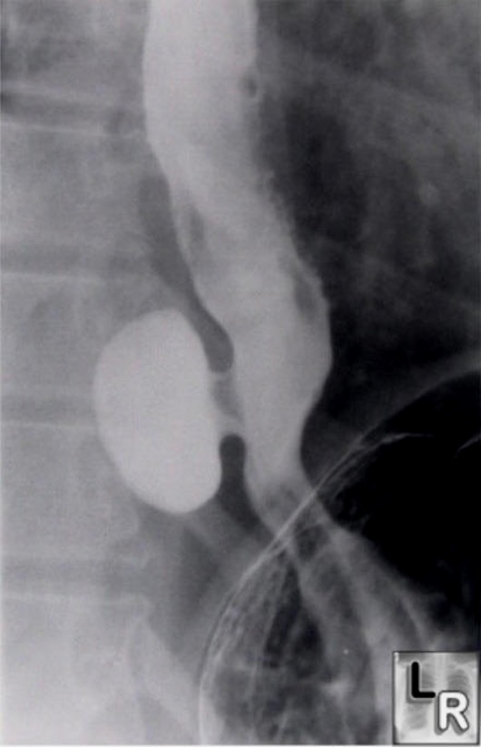 <p>Out pouchings in the mid or distal esophageal wall secondary to motility disorders or strictures are known as ______</p>