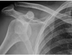 <p>What type of shoulder dislocation can be seen here?</p>