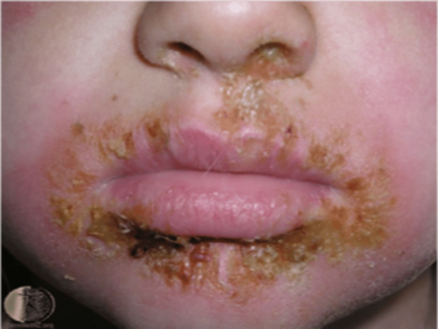 <p>name the skin pathology</p>
