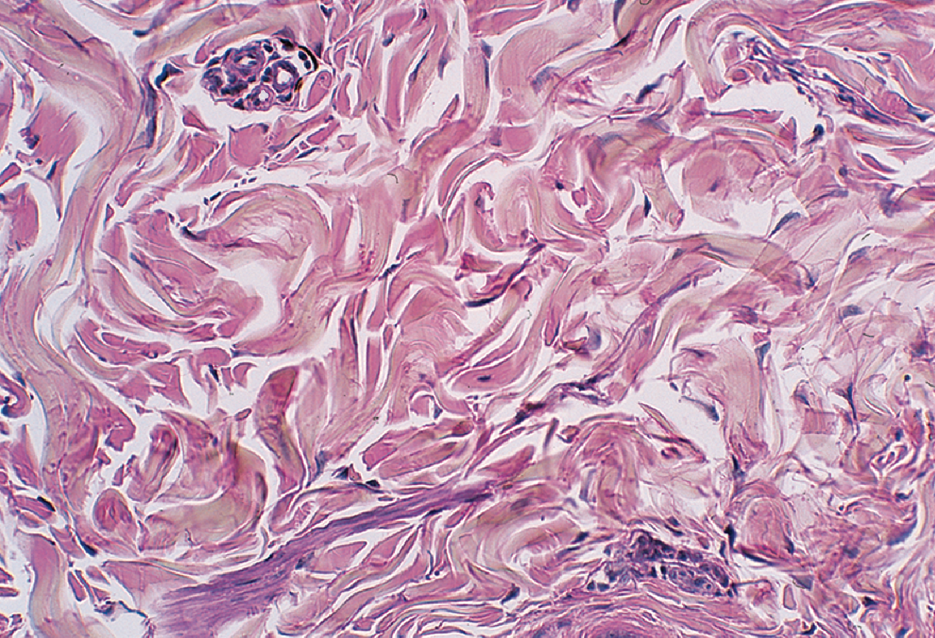 <p><span style="color: blue"><strong>non-parallel </strong></span><strong>collagen fibers</strong></p><p>{ in irregular patterns } </p>