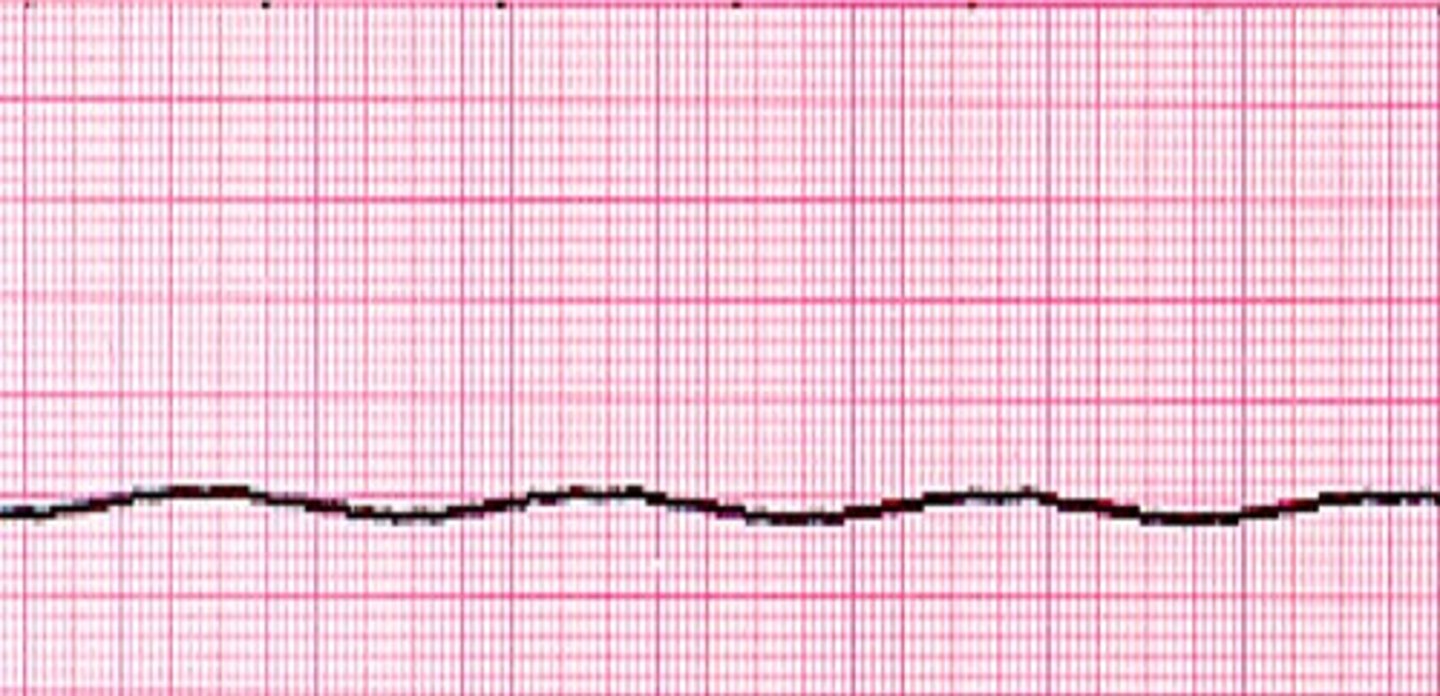 <p>What does the ECG show?</p>