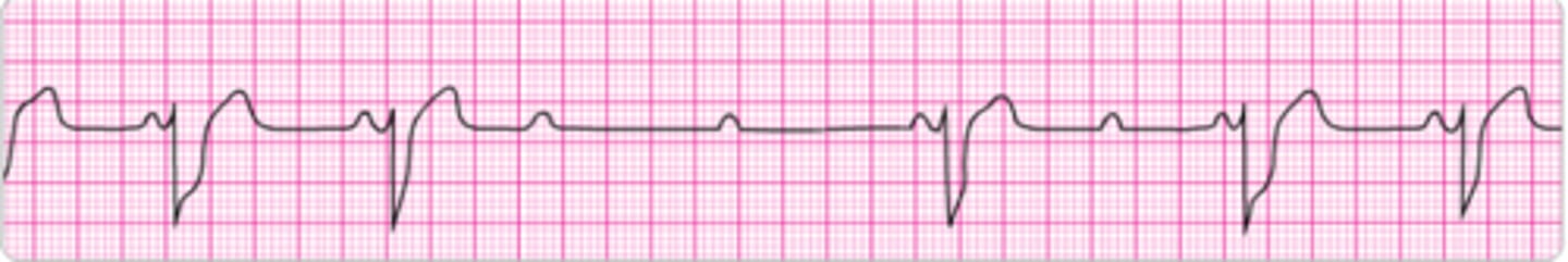 <p>Identify the rhythm.</p>