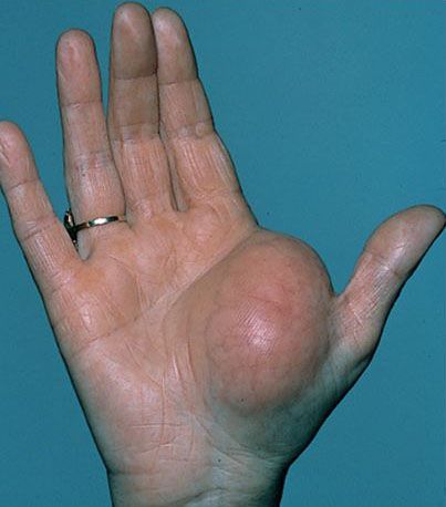 <p>What type of skin lesion is this? Give an example.</p>