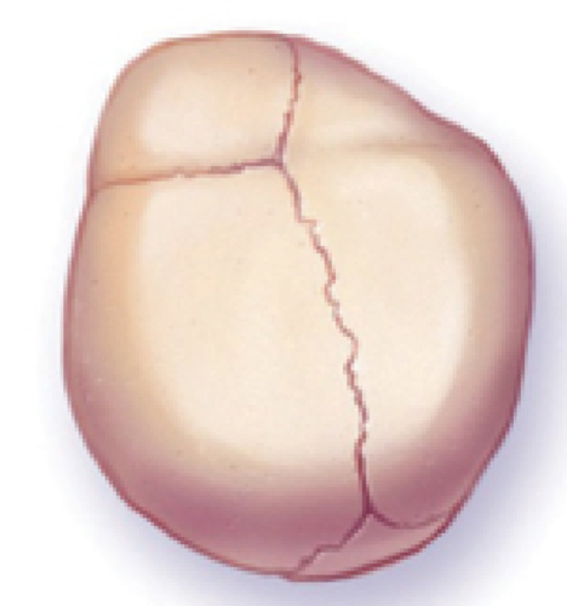 <p>unilateral coronal synostosis</p>