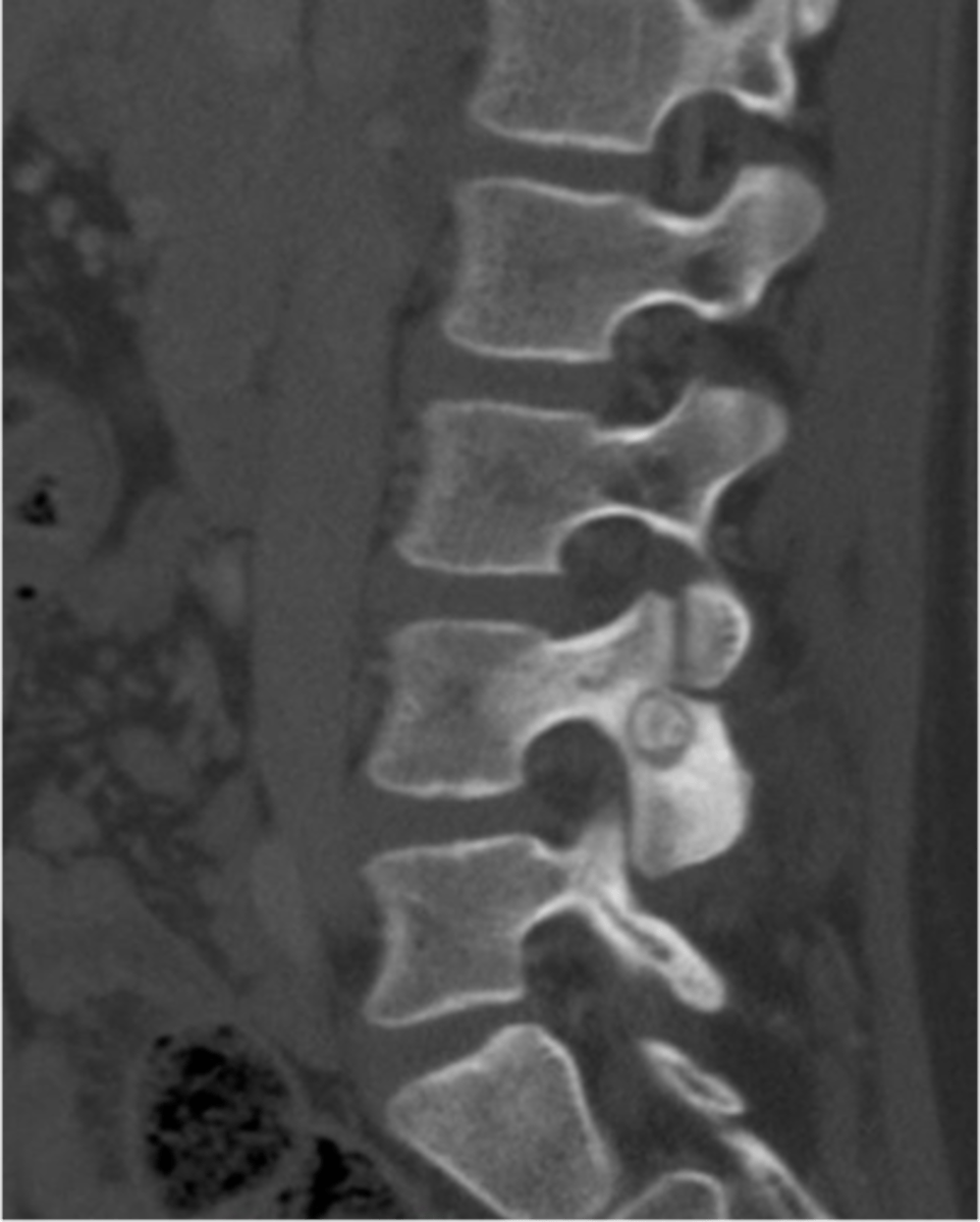 <p>State the spinal radiologic features of osteoid osteoma</p>