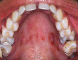 <p><span style="color: blue;"><strong><em><u>SPECIFIC INFECTIONS</u></em></strong></span></p><p>Syphilis (oral)</p><ul><li><p>Clinical Signs</p></li><li><p>Etiology</p></li><li><p>Treatment</p></li></ul><p></p>
