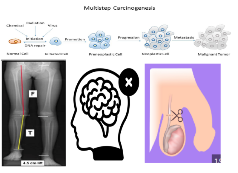 <ol><li><p>late carcinogenesis</p></li><li><p>Retardation of bone/ cartilage growth</p></li><li><p>intellectual impairments</p></li><li><p>sterilization (if gonads are in field)</p></li><li><p>Other organ specific effects</p></li><li><p>psychosocial effects</p></li></ol><p></p>