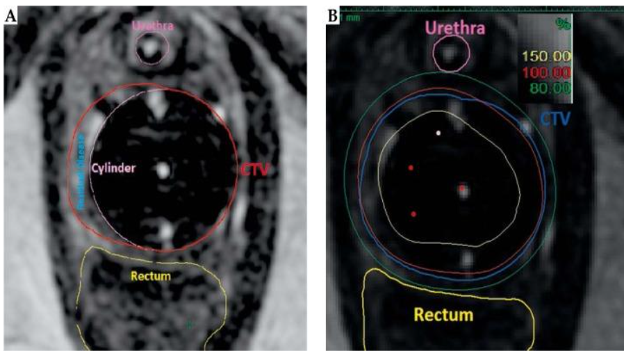 <p>give an example typical dose prescription for a EBRT + brachy boost for vaginal cancer</p>