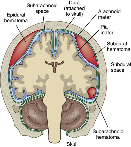 <p>Space that lies outside the dura mater</p>