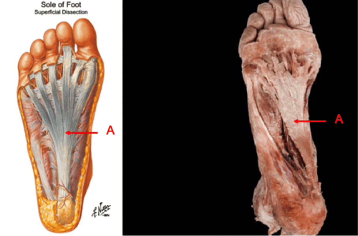 <p>A strong ligament that holds the tarsal bones in an arch and gives you a spring in your step when you walk.</p>