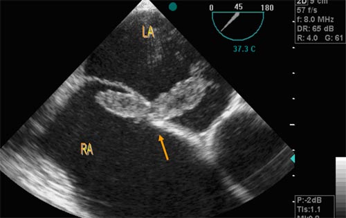 <p>A patient is referred to the echo lab because of symptoms of TIA's.&nbsp; The patient had an echo previously which showed a small patent foramen ovale.&nbsp; A TEE is performed and reveals the above diagnosis.</p><ul><li><p>Normal inter-atrial septum</p></li><li><p>Catheter protruding through the intra-atrial septum</p></li><li><p>A large clot lodged in the patent foramen ovale</p></li><li><p>An ASD closure device</p></li></ul><p></p>