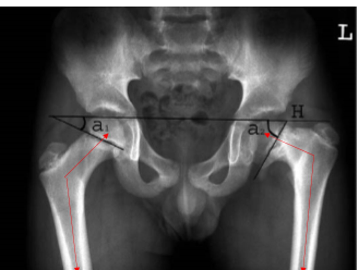 <p>limb = SHORTER</p><p>shear forces = HIGHER</p><p>moment arm of glut med = LONGER</p><p>joint reaction forces = LESS</p><p>joint congruency = INCREASED</p><p>joint stability = GREATER</p><p>articular cartilage pressure = LOWER</p><p>*more overlap of femoral head and acetabulum</p>