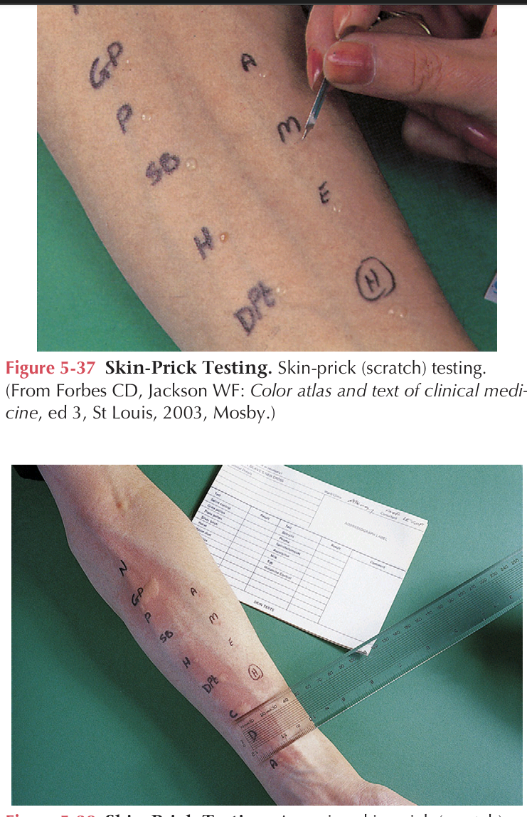 <p>IT is used to detect immediate hypersensitivity reactions. Drops of allergen in solution are placed on the skin. The skin is pricked to a depth of about 1 mm by passing a lance or needle through the solution and into the skin. The sites are evaluated in about 30 minutes for characteristic wheal formation indicating positive reactions</p>
