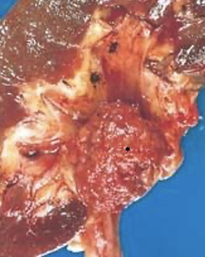 <p>What pathology is indicated at the asterisk? What exam finding is commonly associated with this pathology?</p>