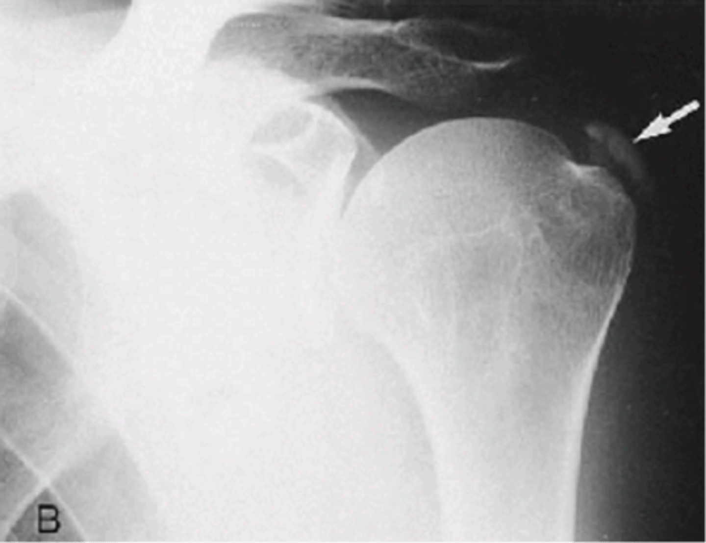 <p>Another term for hydroxyapatite deposition disease (HADD)</p>