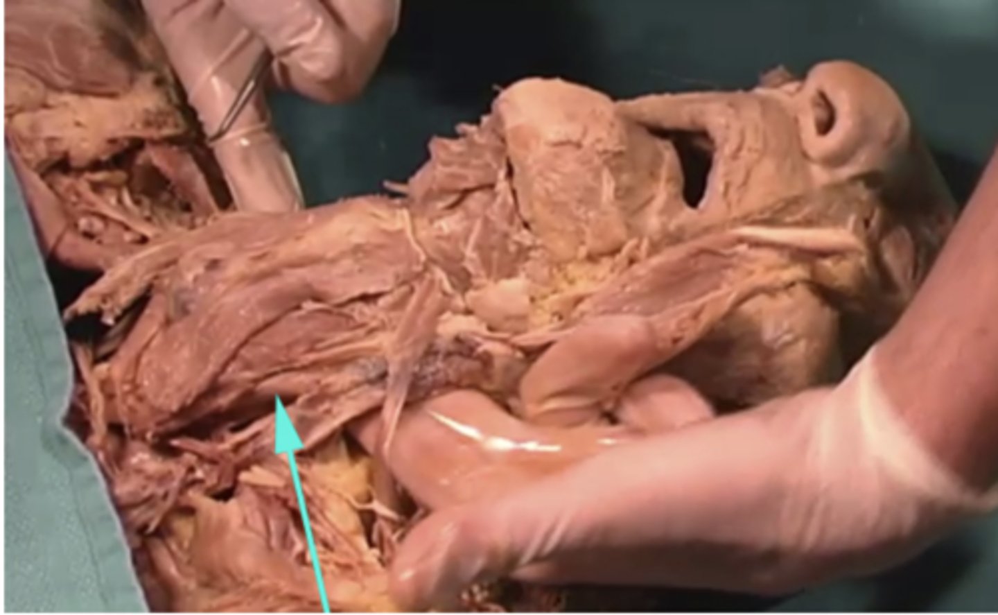 <p>What is the name of this region as indicated by the arrow?</p><p>-internal jugular vein</p><p>-common carotid artery</p><p>-common carotid vein</p><p>-internal jugular artery</p>