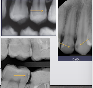 <p>triangular shape gets lost, lesion gets bigger due to curvilinear or “s-shaped” arrangement of dentin tubules</p>