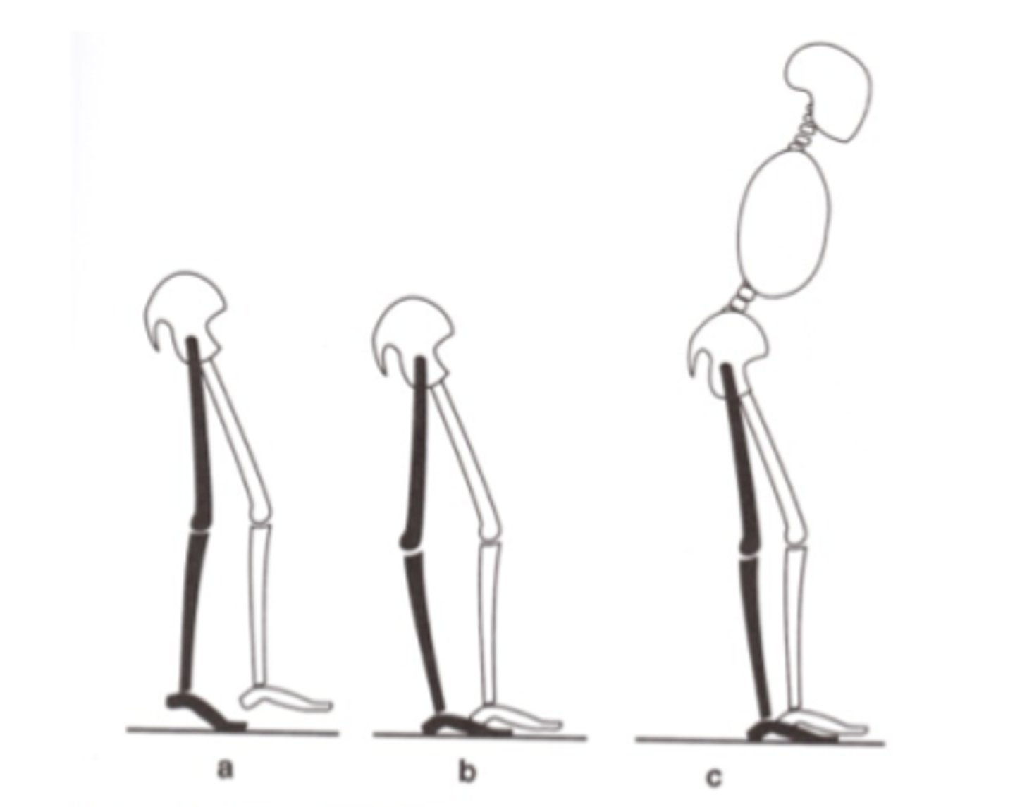 <p>-Quad weakness</p><p>-Excessive ankle PF: causes shortened stride length and reduced velocity</p><p>Substitutions:</p><p>1) premature heel of</p><p>2) knee hyperextension</p><p>3) forward trunk lean</p>