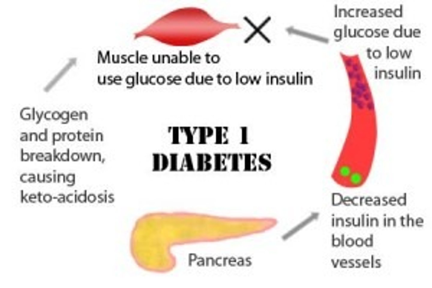 <p>- Minority of Diabetes </p><p>- Occurs in children and young adults </p><p>- WBC attacks insulin-producing islets (viral infection) or hereditary factors</p><p>- insulin-dependent </p><p>- chartered weight loss with increased appetite </p>