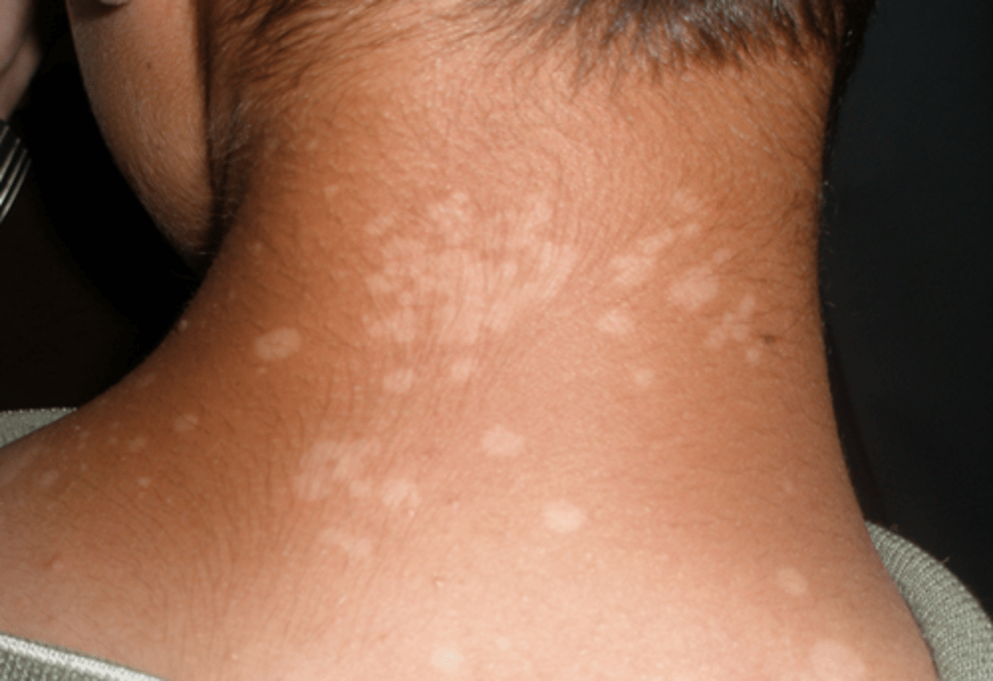 <p>fair-skinned = scaling brown macules</p><p>skin of color = hypopigmented macules</p><p>trunk and extremities</p>