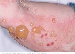 <p>PP/E: autoimmune disorder<br>adverse mx reaction</p><p>RF: elderly<br>groin<br>axillae<br>trunk<br>thighs<br>flexor forearms</p><p>CM:<br><u>urticaria:</u> large+tense subepidermal bullae<br>can persist for months.years</p><p>DX: immunofluorescence of normal skin<br>blister edge biopsy</p><p><u>nikolsky sign:</u><br>push blister→further separation of the dermis</p><p>TX: high-dose prednisone x slow taper<br>azathioprine<br>topical steroids</p>