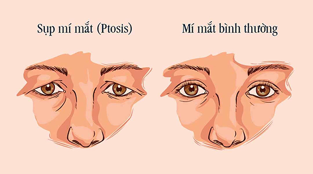 <p>sụp mí</p>