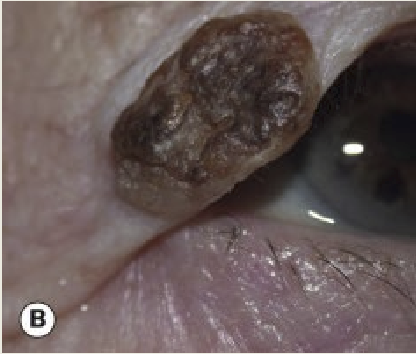 <p>Discrete, brown, greasy plaques that tend to be slow growing. It is more commonly seen din elderly</p>