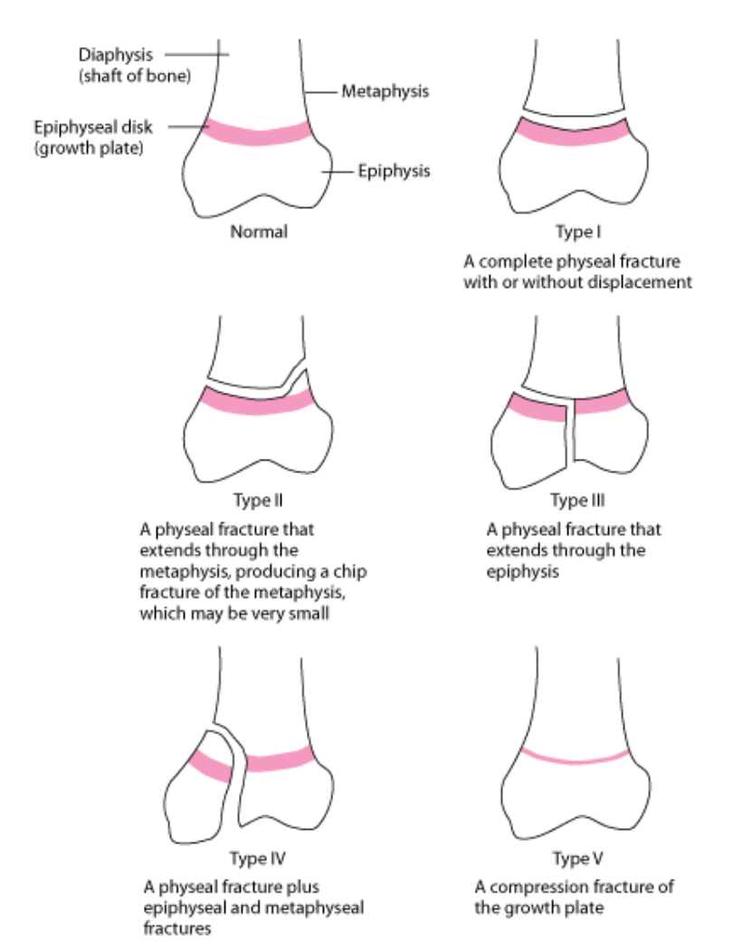 Salter-Harris Classification of Fractures