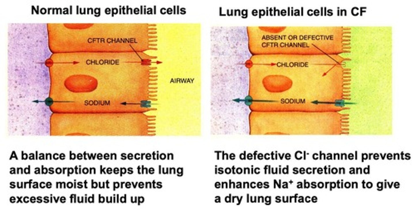 <p>Genetic disorder affecting chloride transport in cells.</p>