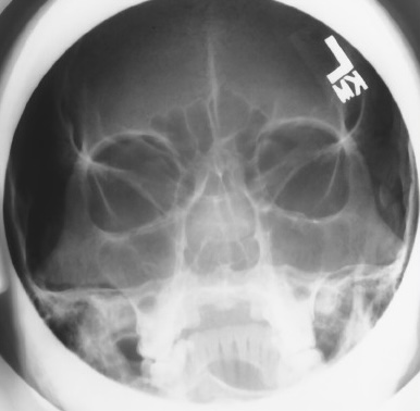 <p>What is this x-ray demonstrating?</p>