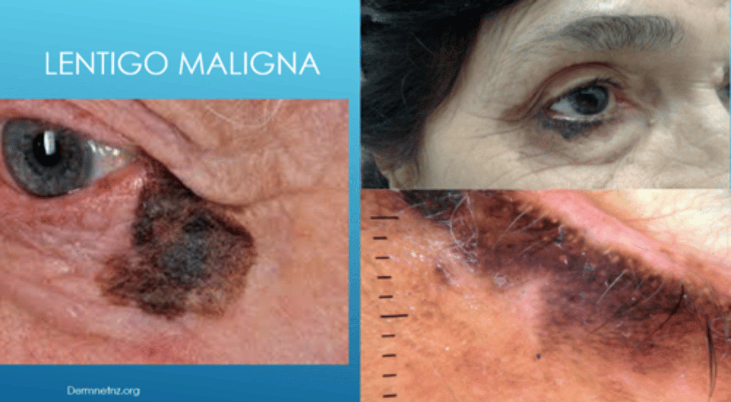 <p>flat, dark brown-black macules that appears like a stain on the skin (irregular/mottled borders)</p>