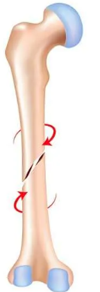 <p>a result of twisting forces</p>