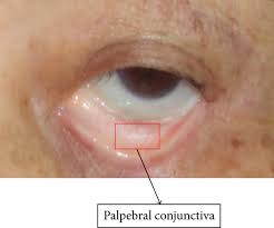 <p>Thin, protective mucous membrane that covers the inner eyelid</p>