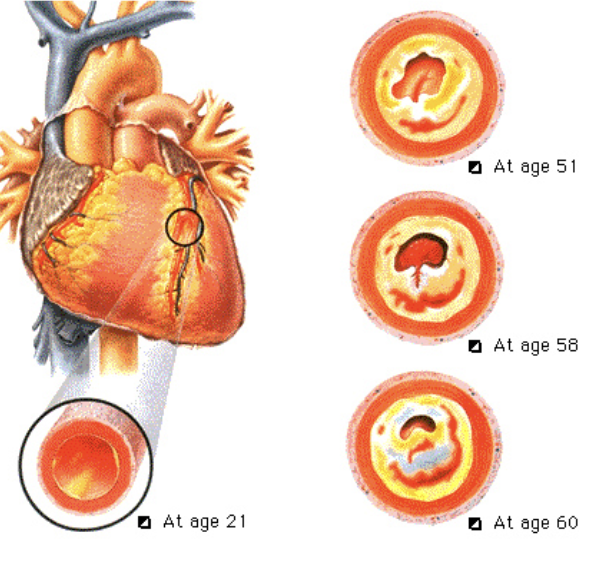 <ul><li><p><span>The narrowing of coronary arteries due to plaque build-up</span></p></li><li><p><span>Causes more than 90% of heart attacks.</span></p></li></ul>