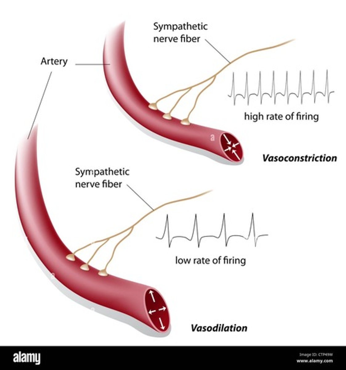 <p>Narrowing of blood vessels, reducing blood flow.</p>