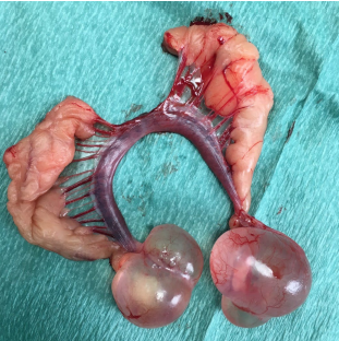 <p>Ovarian cysts often increase in size</p><p>with time, and the pressure of the cyst</p><p>on other organs may cause ?</p><p>What else can form?</p><p>DX?</p>