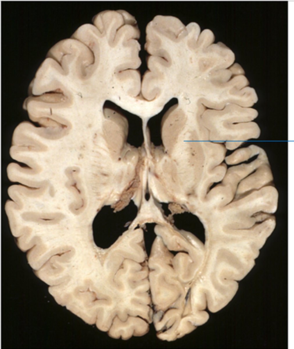 <p>Bounded by the lentiform nucleus and head of the caudate nucleus</p><p>-Anterior thalamic radiation; corticopontine</p>