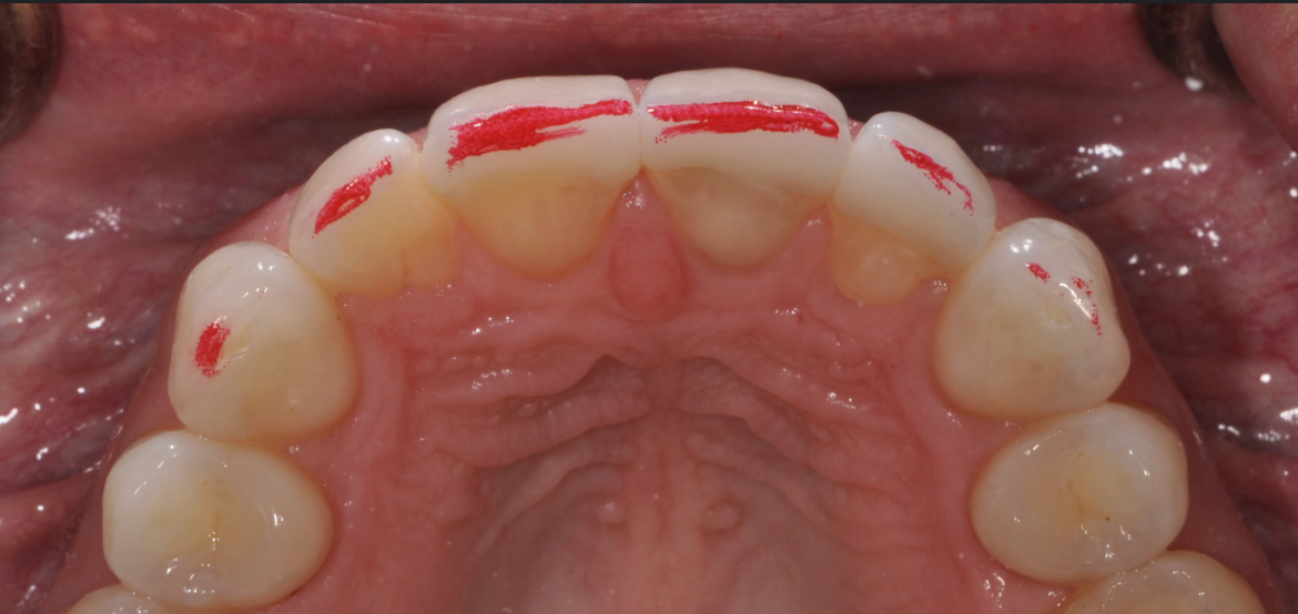 <p>Chewing surface of the anterior teeth.</p>